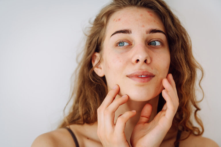 Portrait of beautiful young woman with inflammations on skin of her face. Medicine and cosmetology